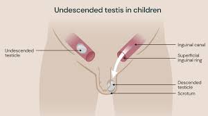 Undescended Testis Treatment in Faridabad – Expert Pediatric Surgical Care for Children